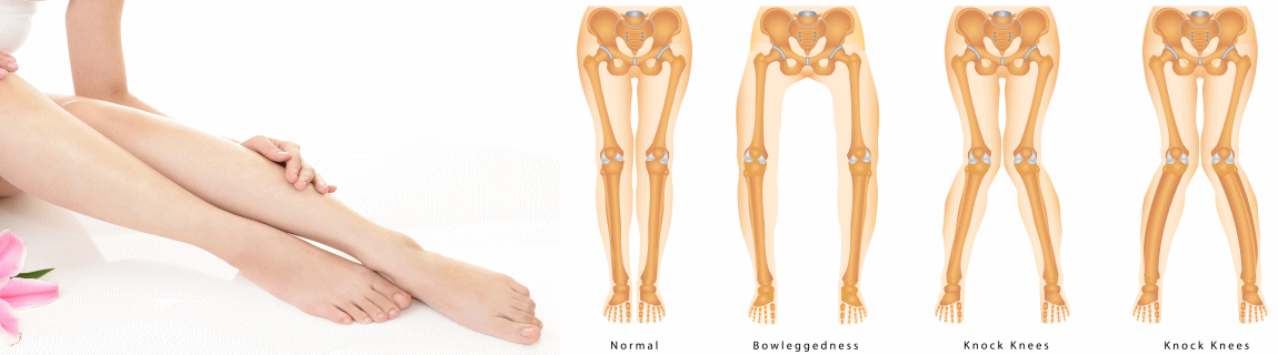 O脚矯正・X脚矯正でおすすめのカイロプラクティックと整体の骨盤矯正（浜松市）
