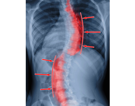 脊柱側湾症を治す方法と予防法のカイロプラクティックと整体（浜松市）